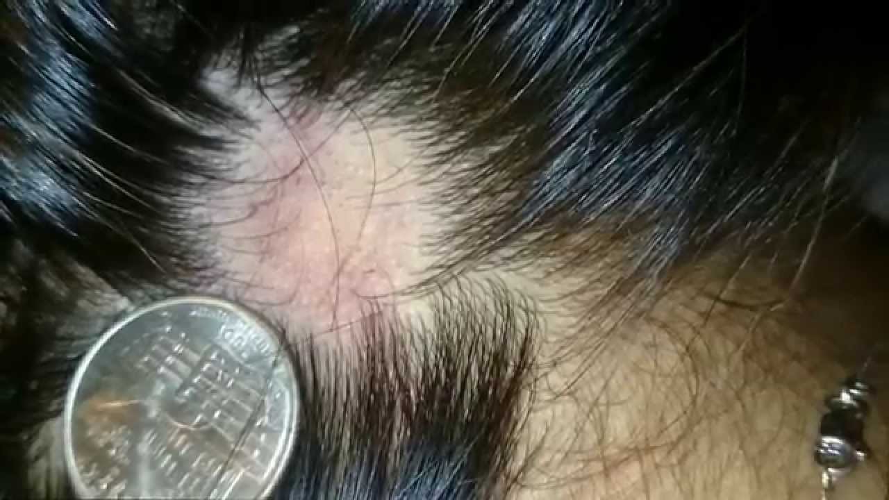 alopecia
